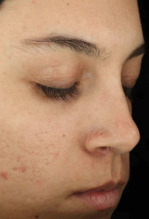 Before Mobile CC Serum Subject 1