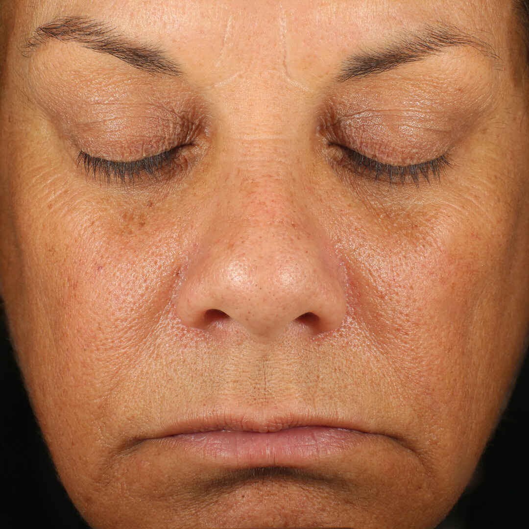 Retinol Skin Brightener 1% după