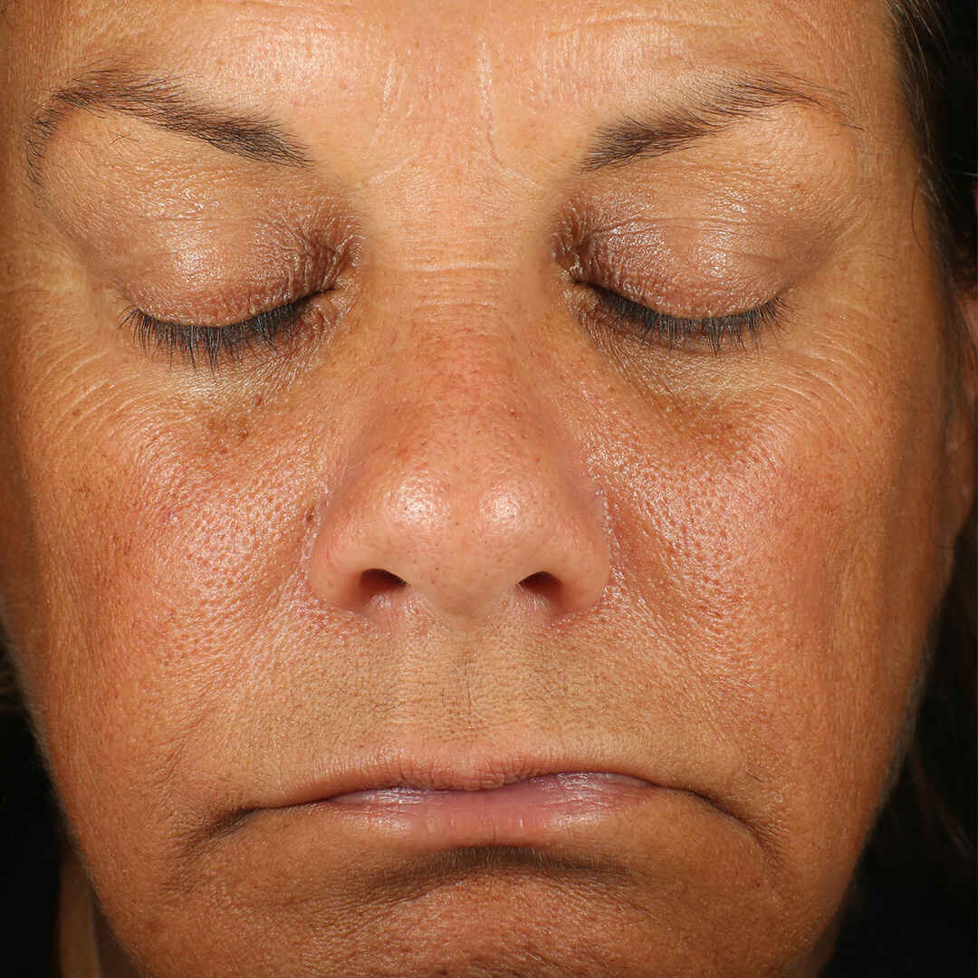 Retinol Skin Brightener 1% înainte