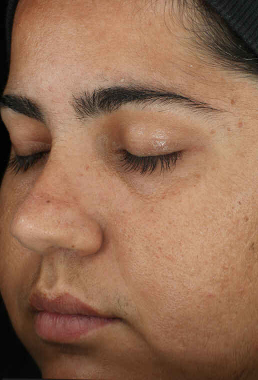 Retinol Skin Brightener 1%:2 după