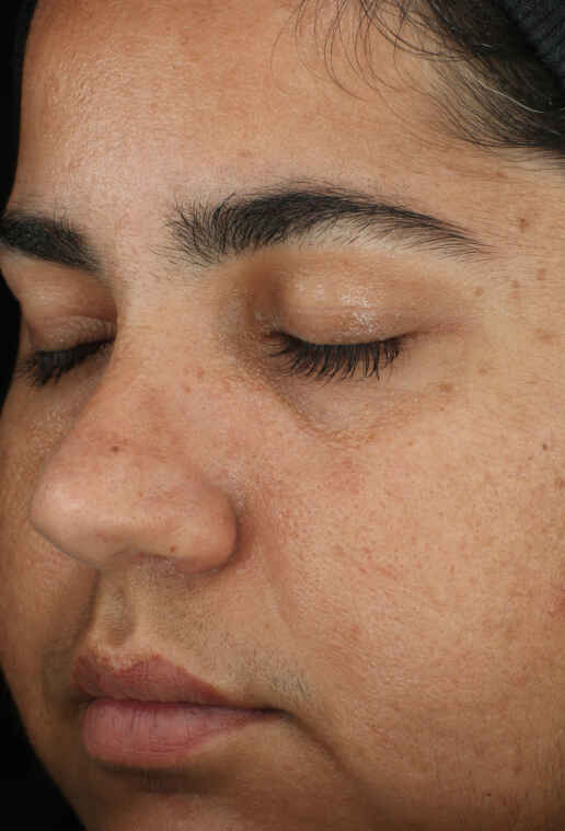 Retinol Skin Brightener 1%:2 înainte