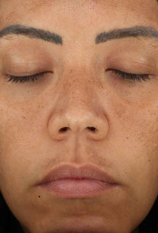 Retinol Skin Brightener 1%:3 după