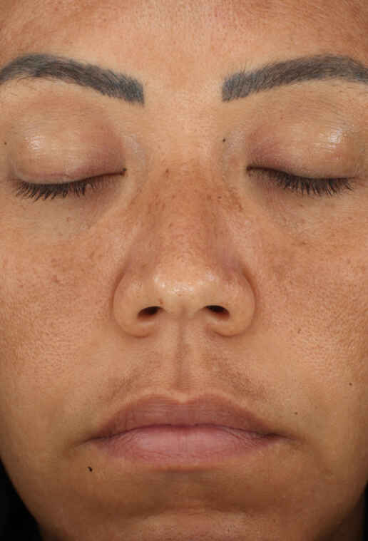 Retinol Skin Brightener 1%:3 înainte